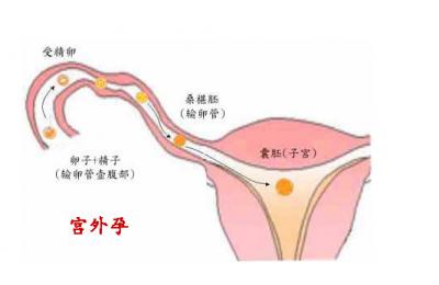 随州宫外孕的确诊有哪些方法