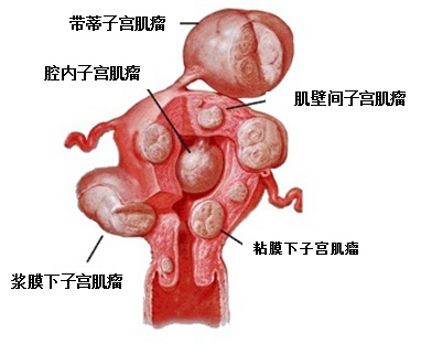 患有子宫肌瘤要做哪些检查